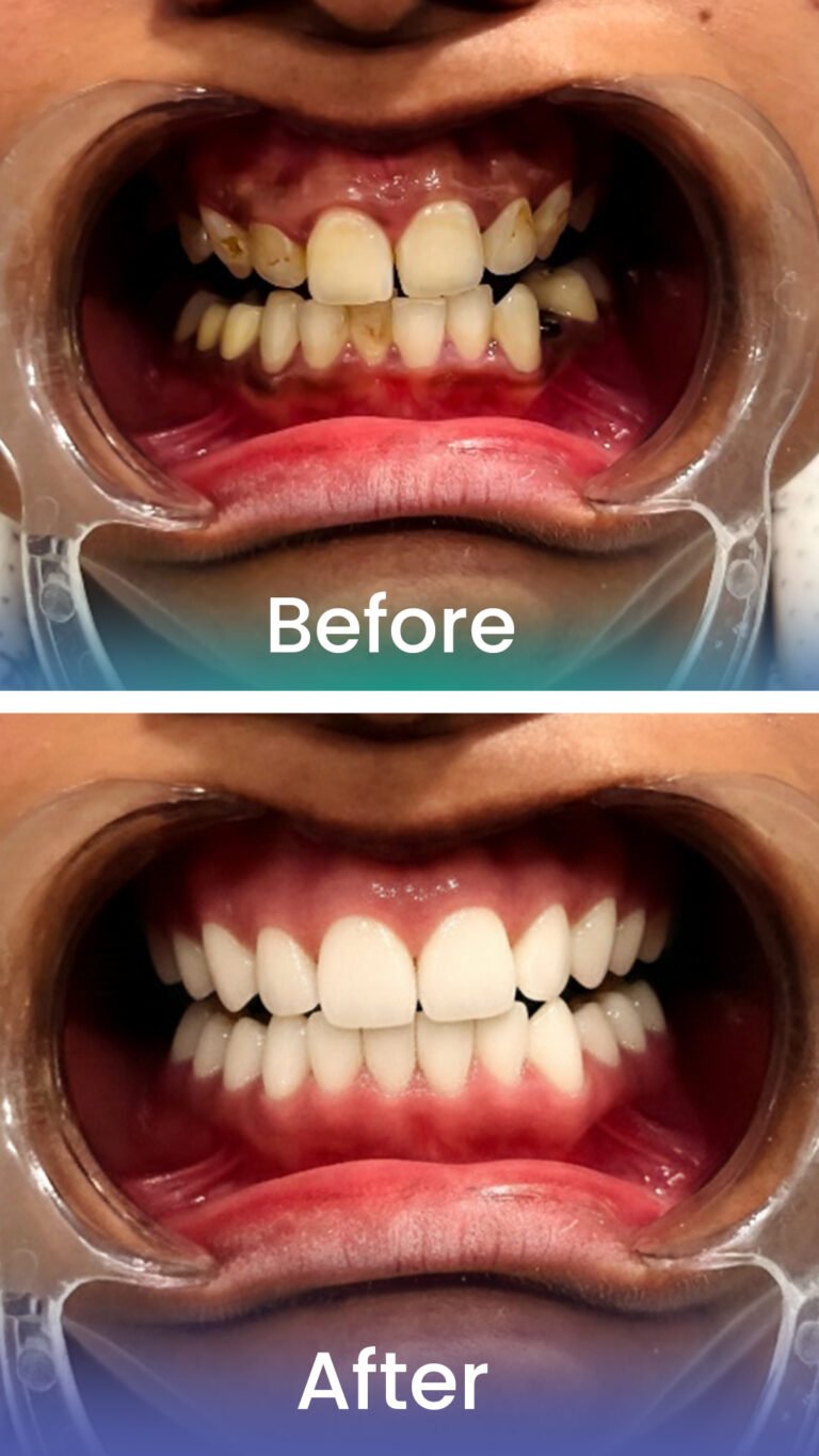 Before and after: complete smile makeover
