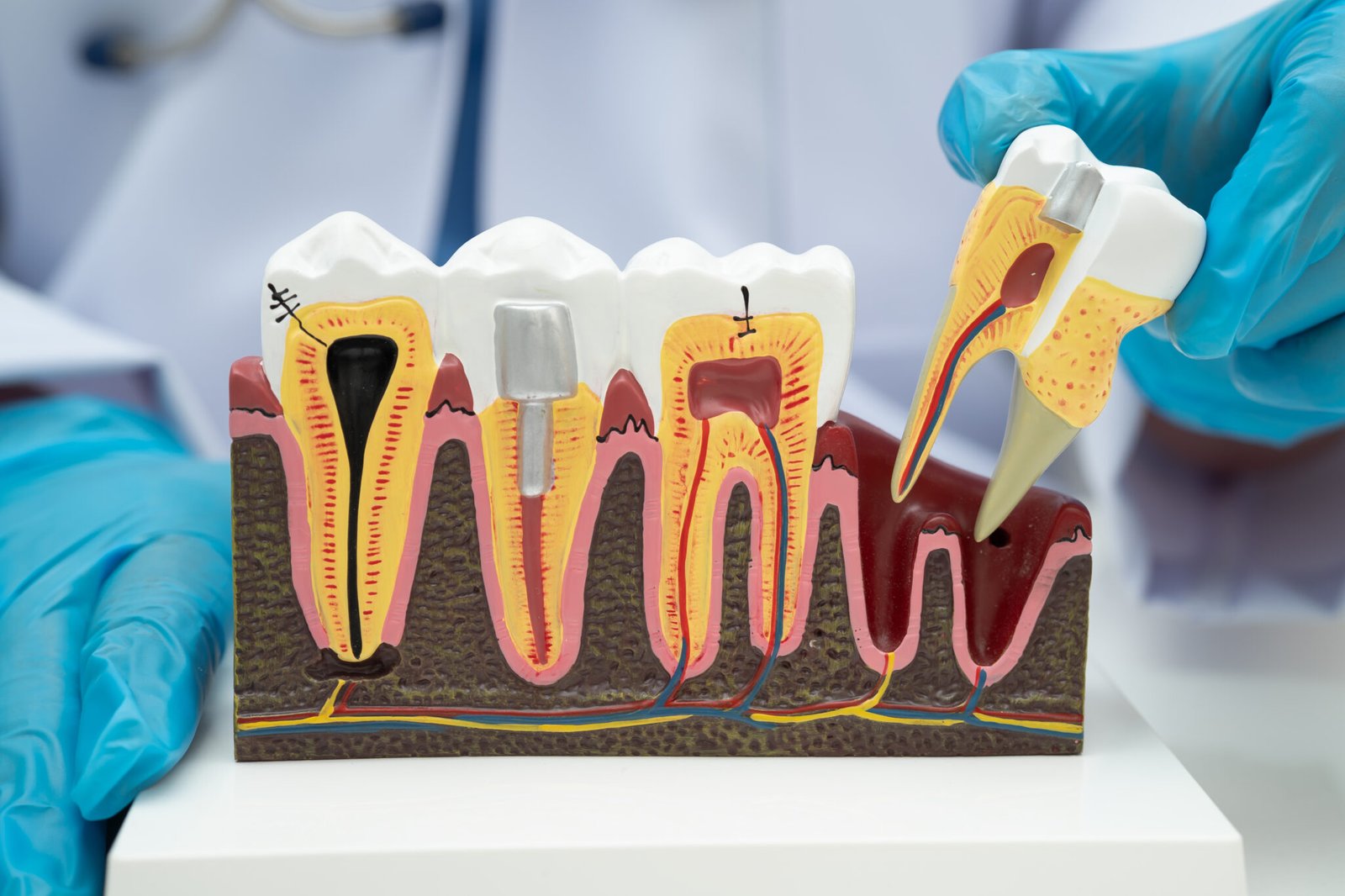 A dental implant being prepared by a specialist