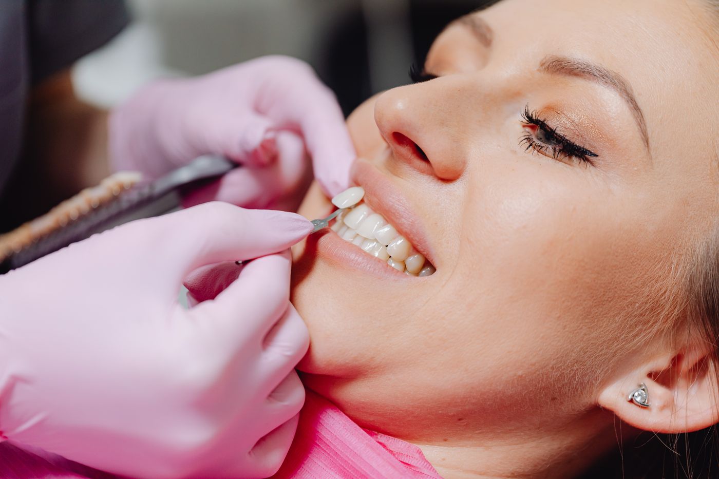 Dental veneers
